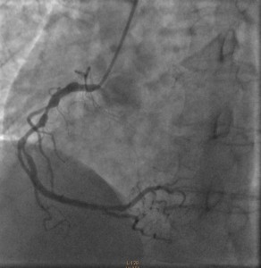 Case 2 angiogram