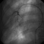 Right wedge angiogram (click to enlarge)