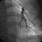 Left wedge angiogram (click to enlarge)
