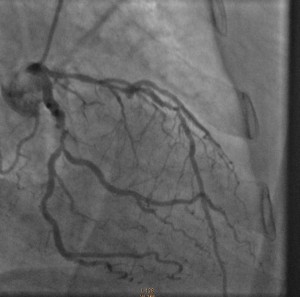Case 1 angiogram
