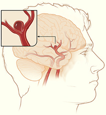 brainaneurysm1